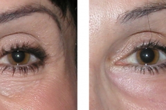 imita ridurile de sub ochi la 25 de ani botox 3 zone
