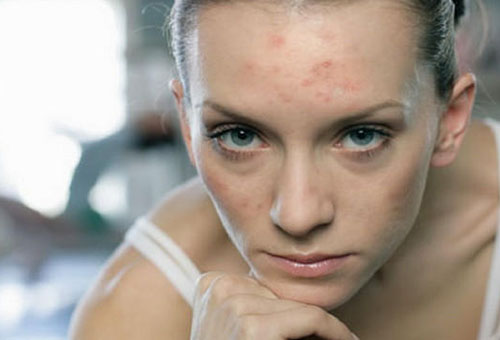 honing masker acne